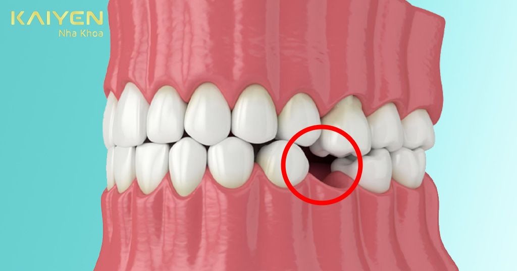 Răng vàng giá bao nhiêu sẽ phụ thuộc vào số lượng răng mất và nhiều yếu tố khác