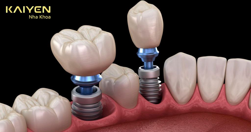 Răng Implant ngăn ngừa tình trạng tiêu xương hàm