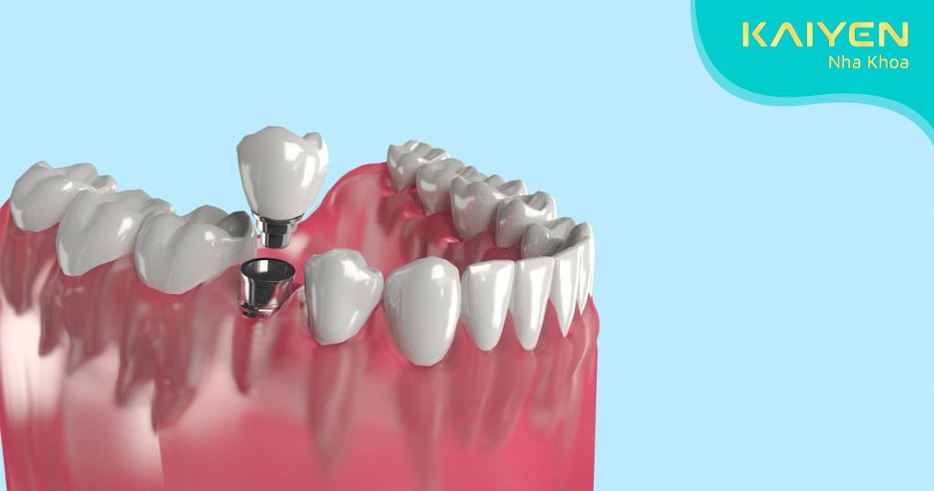 Đa dạng vị trí cấy ghép trụ Implant giúp phục hình răng hoàn hảo