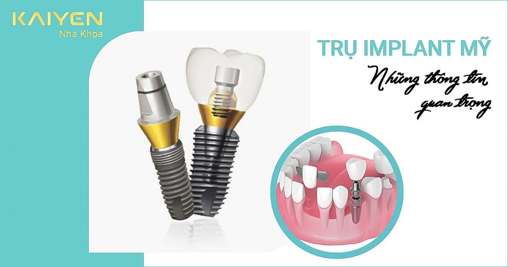 Trụ Implant Mỹ và những thông tin quan trọng cần biết