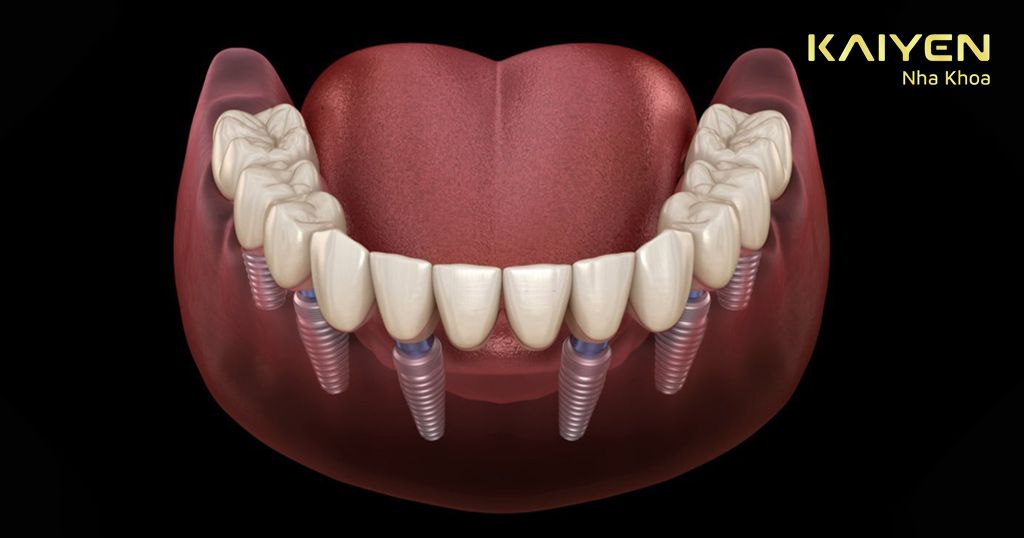 Kỹ thuật cấy Implant All-on-6