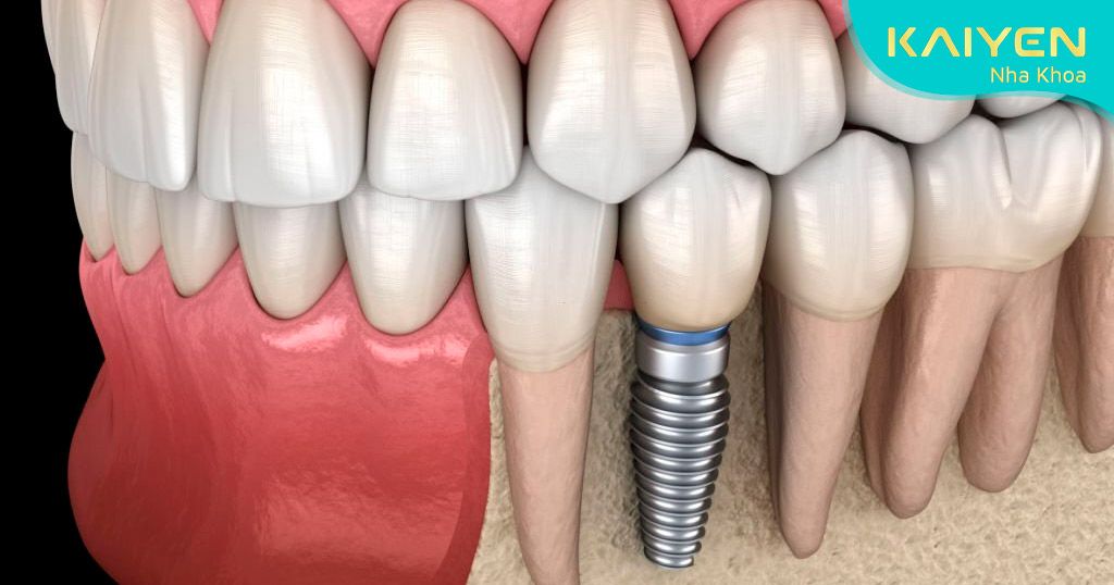 Răng Implant đạt tính thẩm mỹ cao như răng thật
