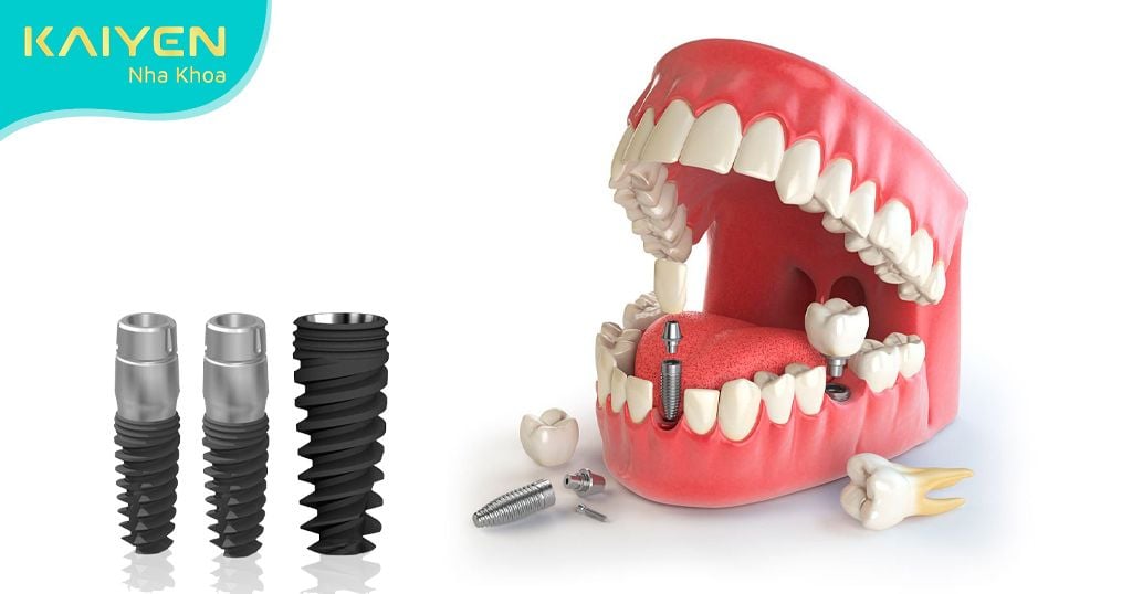 Implant Yes Biotech phù hợp với tất cả đối tượng khách hàng mất răng