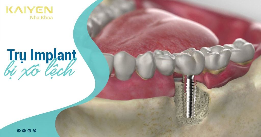Cắm răng Implant bị xô lệch: Nguyên nhân và cách khắc phục hiệu quả