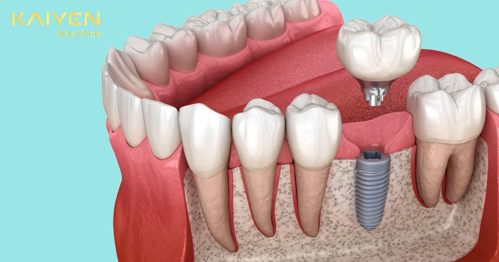 Trụ Implant bị lệch do đào thải trụ răng