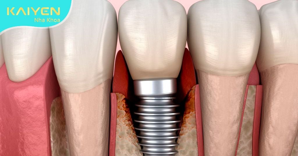 Viêm đau quanh trụ Implant.