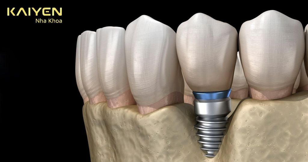 Cách khắc phục tình trạng cắm răng Implant bị xô lệch