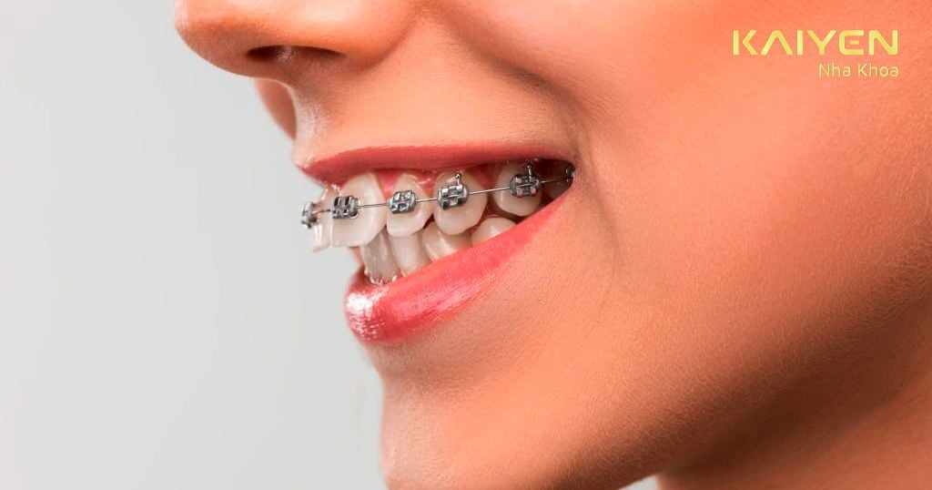 Răng bị hô thì nên chỉnh nha chứ không phải bọc sứ