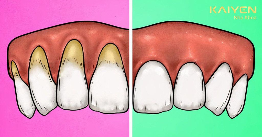 Tụt nướu răng vừa ảnh hưởng đến sức khỏe răng miệng, vừa làm mất thẩm mỹ