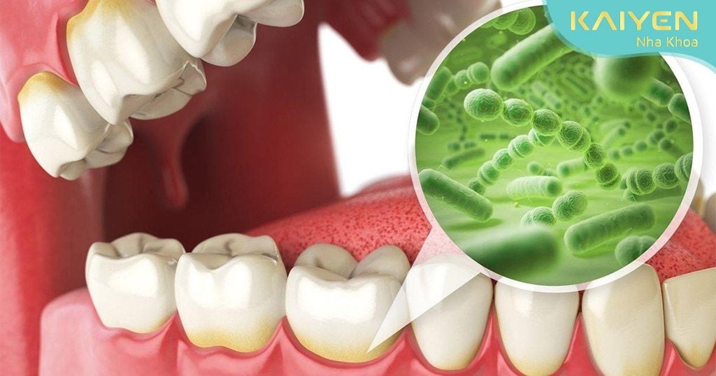 Vệ sinh răng miệng không tốt tao điều kiện cho vi khuẩn phát triển có thể gây tụt nướu