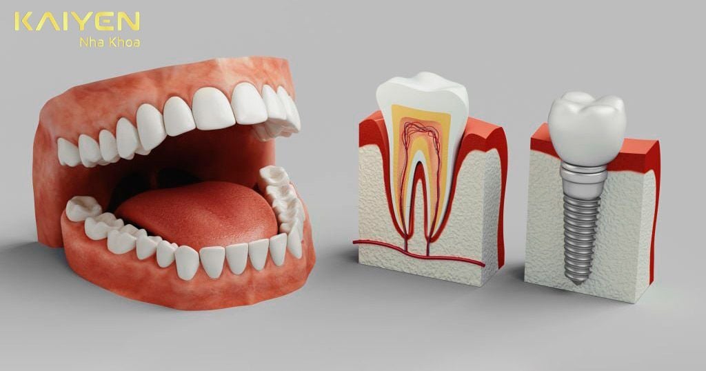 Ưu nhược điểm của trồng răng Implant: 10 điều chuyên gia tiết lộ