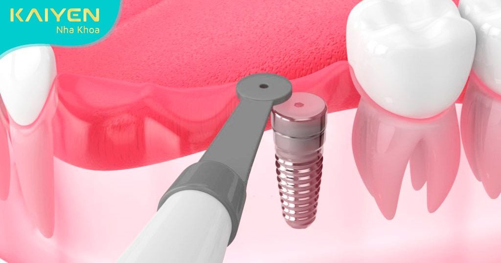 Răng Implant an toàn, lành tính