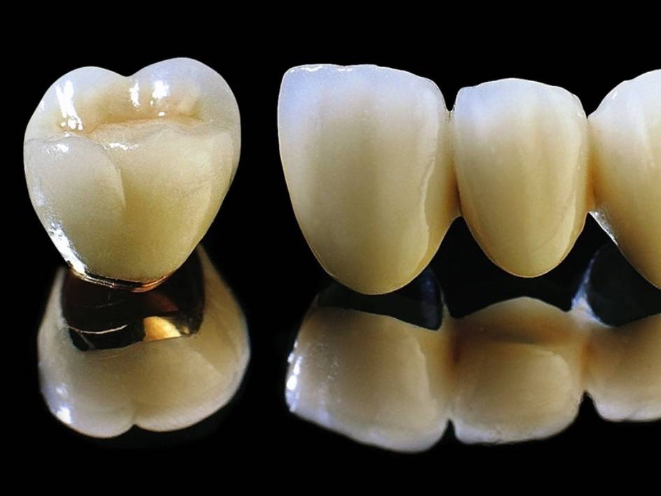 ưu điểm các loại răng sứ