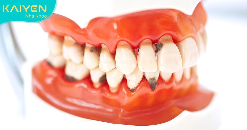 Quy trình niềng răng sai kỹ thuật có thể gây ra nhiều hậu quả nghiêm trọng