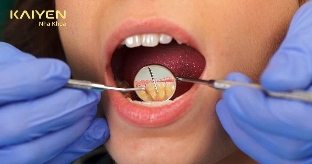 Lấy cao răng để điều trị viêm lợi sau khi bọc răng sứ