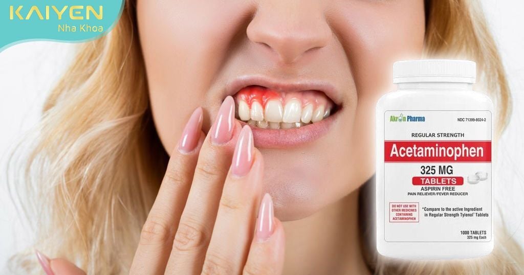 Acetaminophen giúp giảm các cơn đau viêm nướu từ nhẹ đến vừa phải