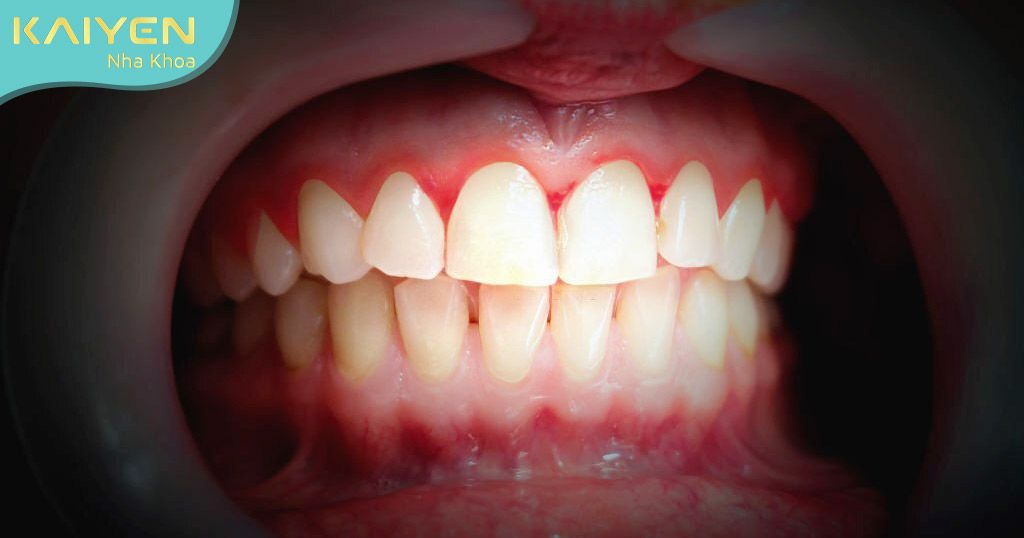 Viêm nướu răng có hiện tượng sưng, đỏ, đau