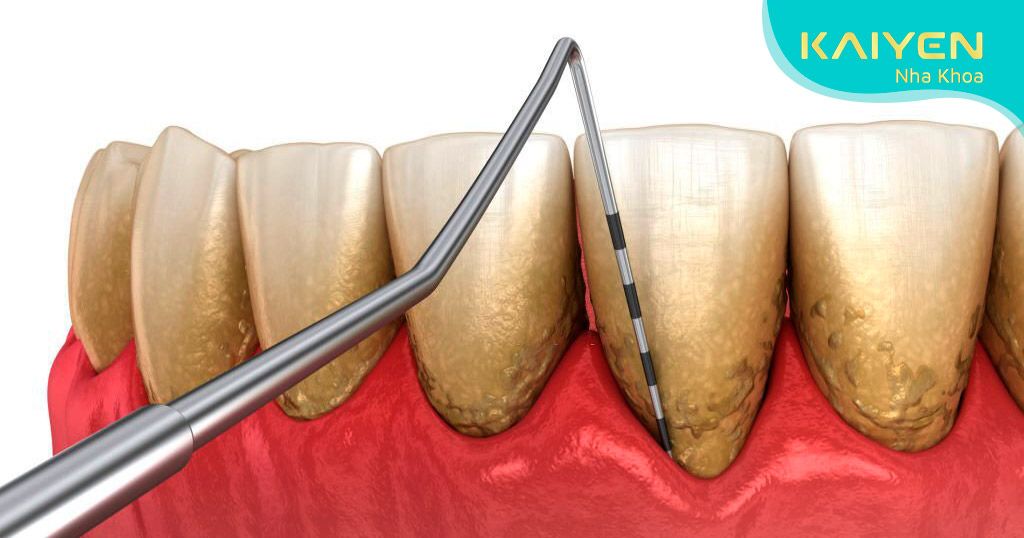 Kiểm tra tình trạng viêm nha chu trước khi trồng răng Implant