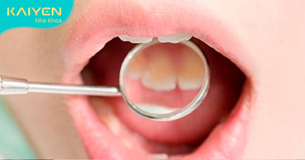Điều trị triệt để bệnh răng miệng trước khi cấy ghép Implant