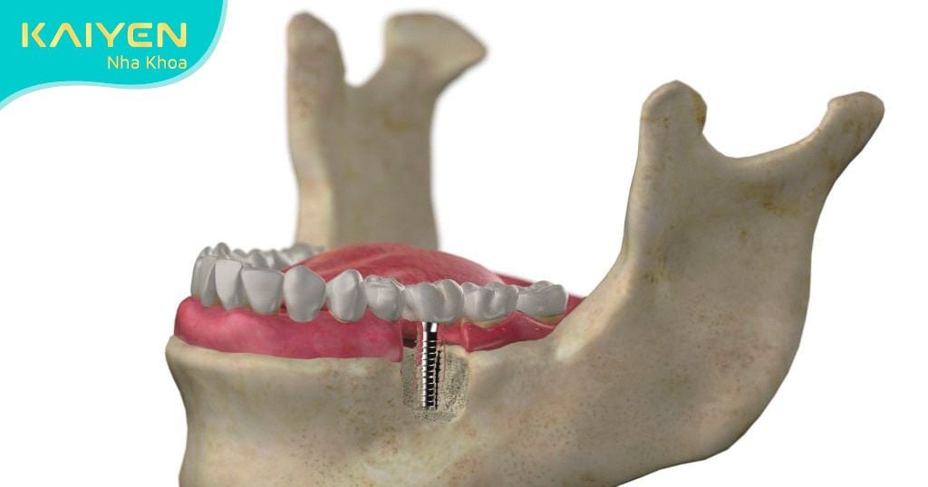 Trồng răng Implant yêu cầu đạt tiêu chuẩn xương hàm