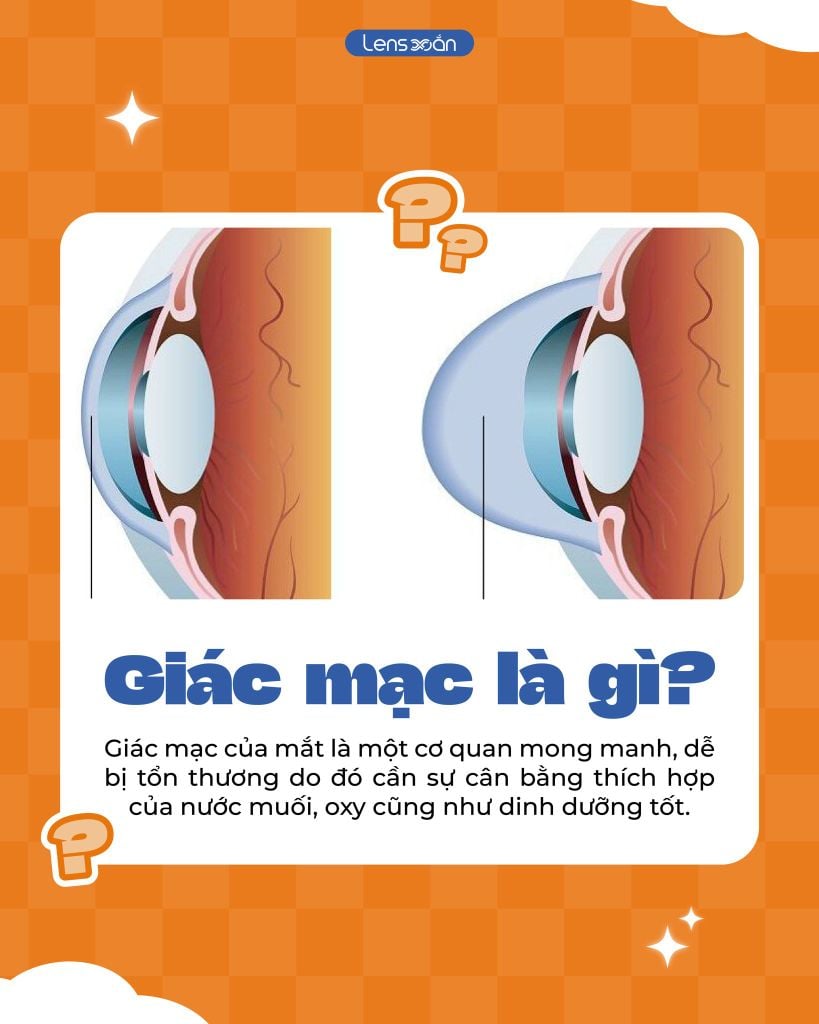 Lỡ ngủ quên khi đeo lens: Những điều bạn cần làm ngay