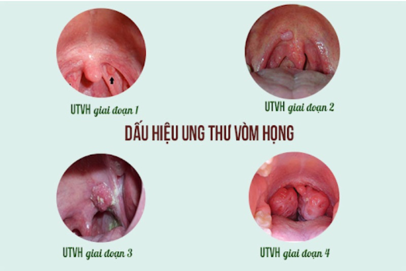 Dấu hiệu ung thư vòm họng