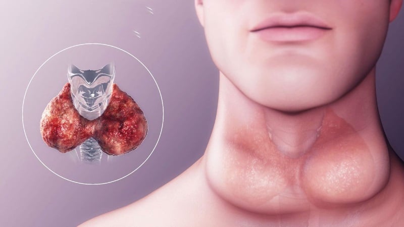 U tuyến gi&aacute;p &aacute;c t&iacute;nh l&agrave; g&igrave;? Nguy&ecirc;n nh&acirc;n, triệu chứng v&agrave; c&aacute;ch chữa &ndash; Dinh  dưỡng y học