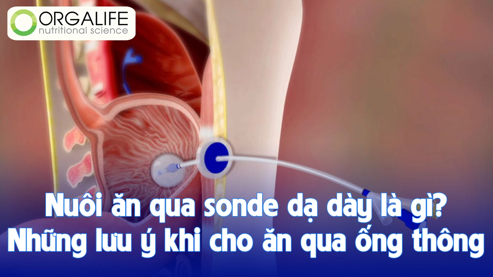 Nuôi ăn qua sonde dạ dày là gì? Những lưu ý khi cho ăn qua ống thông