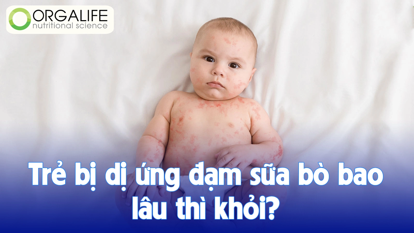 Trẻ bị dị ứng đạm sữa bò bao lâu thì khỏi?