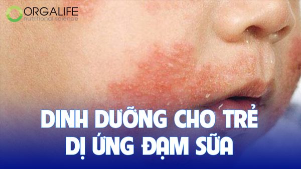 Dinh dưỡng cho trẻ dị ứng đạm sữa