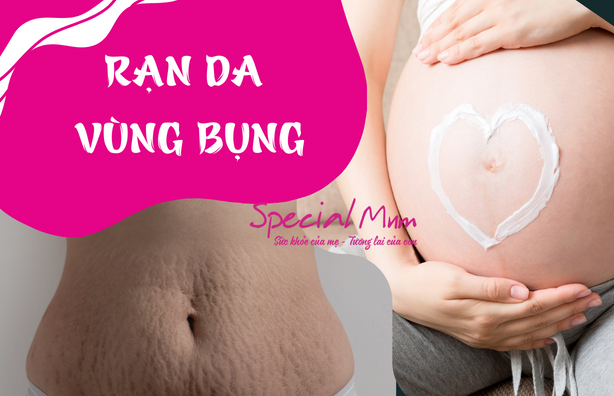 màu sắc rạn da vùng bụng | Special Kid