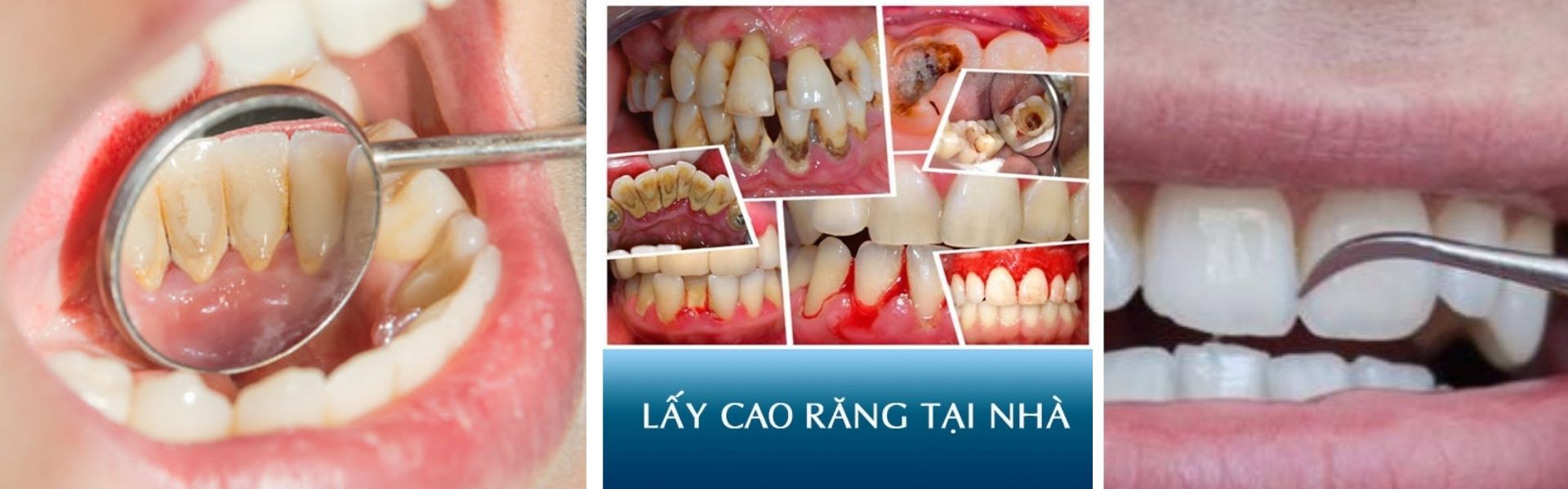 Cạo vôi răng tại nhà có hiệu quả không?