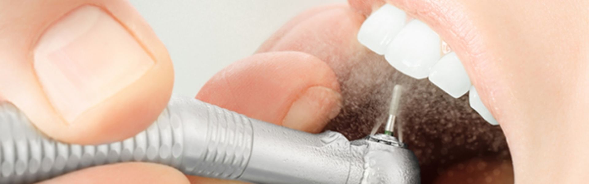 Máy cạo vôi răng bằng sóng siêu âm có nên sử dụng không?