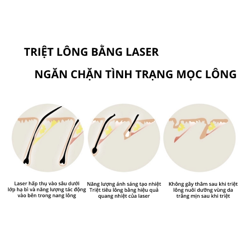 Máy triệt lông IPL laser thiết kế thông minh - Lux Hair