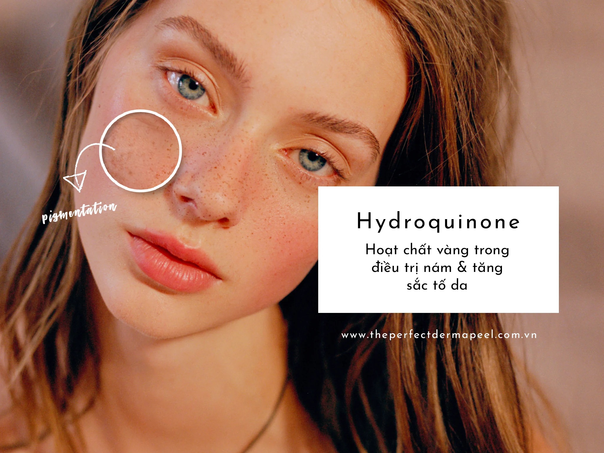 Hydroquinone - Hoạt chất vàng trong điều trị nám & tăng sắc tố da