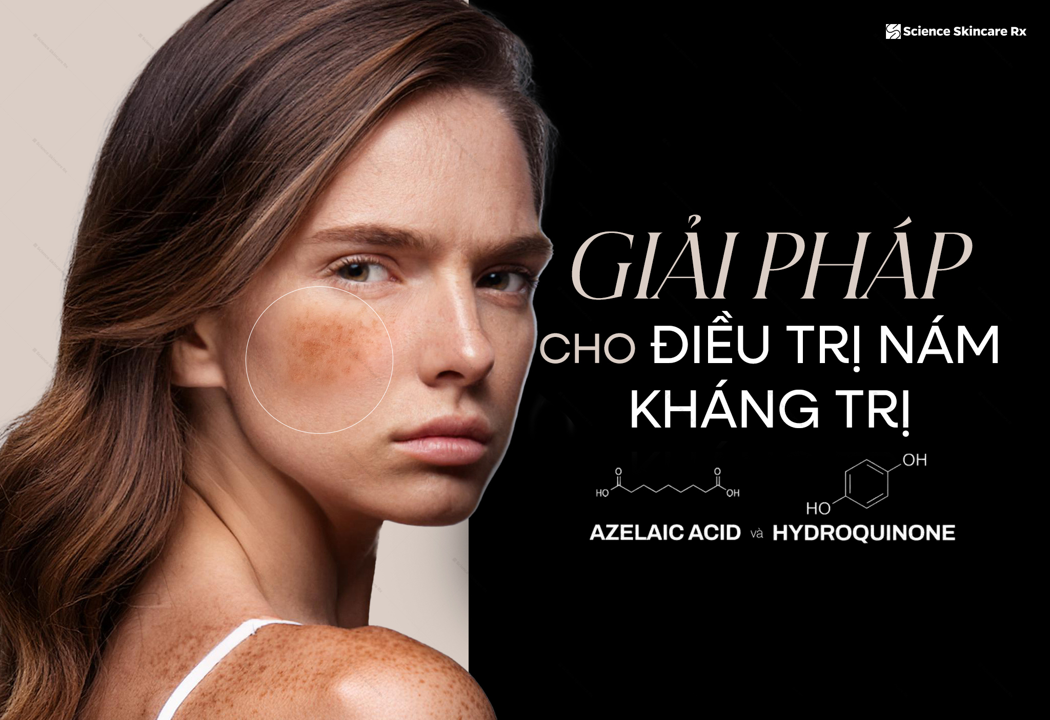 Giải Pháp MỚI Cho Nám Kháng Trị: Laser Kết Hợp Azelaic Acid