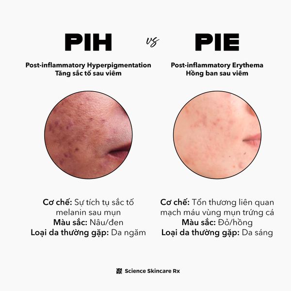 Đối tượng phù hợp với peel da trị viêm nang lông