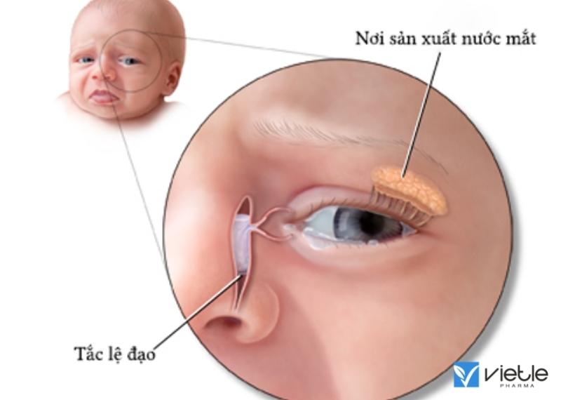 TẮC LỆ ĐẠO: NGUYÊN NHÂN, TRIỆU CHỨNG VÀ HƯỚNG ĐIỀU TRỊ