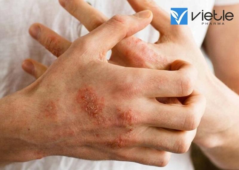 NHỮNG THÔNG TIN VỀ BỆNH Á SỪNG VÀ CÁCH ĐIỀU TRỊ