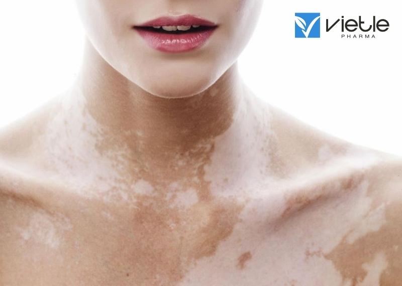 Bạch biến là gì - hiểu rõ về bệnh bạch biến