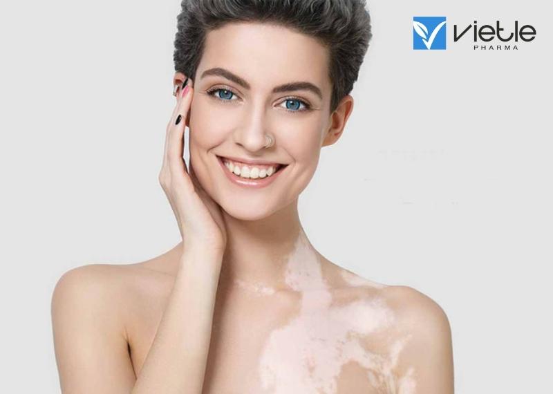 BẠCH BIẾN LÀ GÌ, PHÒNG NGỪA VÀ ĐIỀU TRỊ