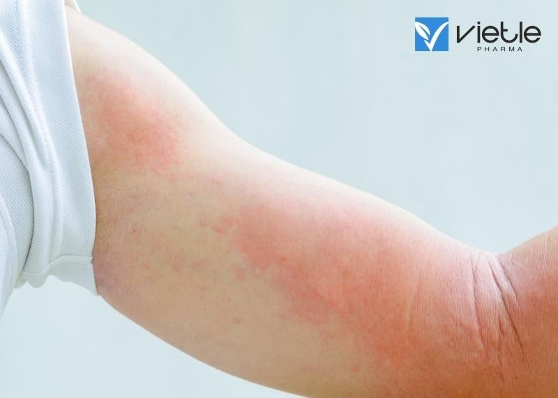 BỆNH MÀY ĐAY VÀ NHỮNG THÔNG TIN CẦN BIẾT