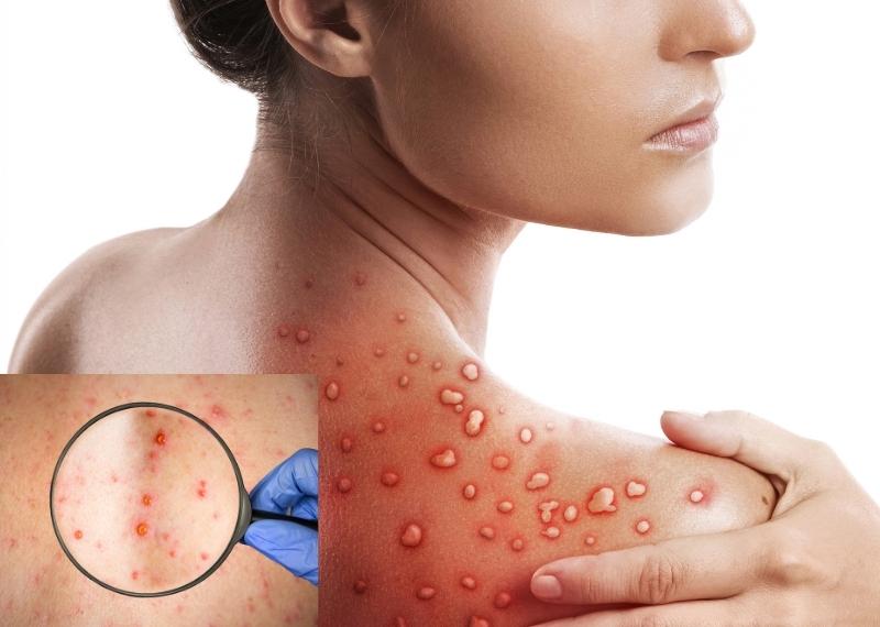 Bệnh đậu mùa khỉ có lây truyền qua đường tình dục?