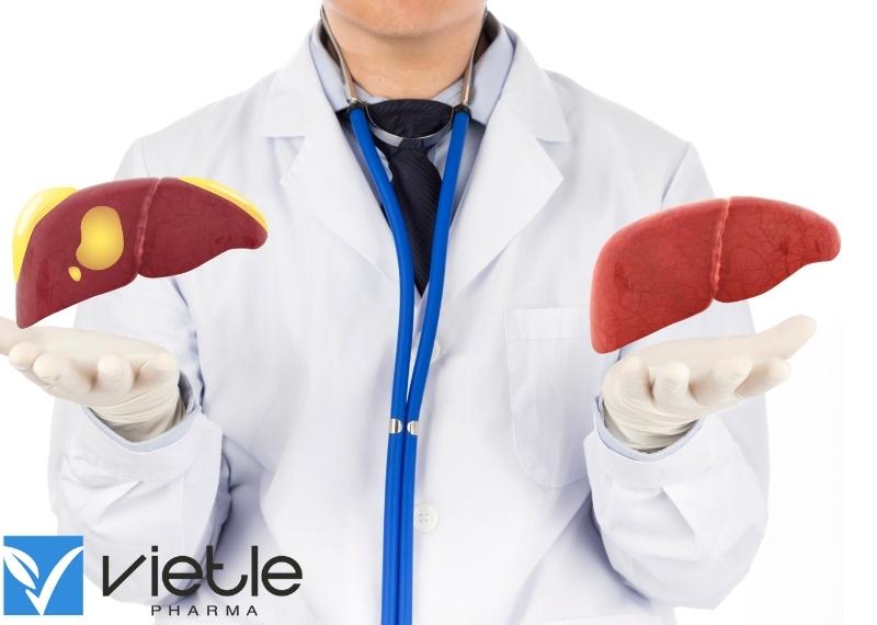 Bệnh gan nhiễm mỡ không do rượu điều trị như thế nào?
