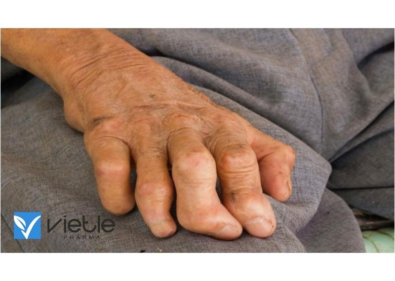 BỆNH PHONG VÀ NHỮNG ĐIỀU CẦN BIẾT