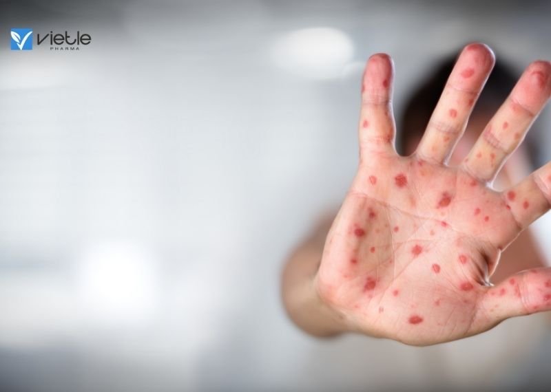BỆNH TAY, CHÂN, MIỆNG VÀ NHỮNG ĐIỀU CẦN BIẾT