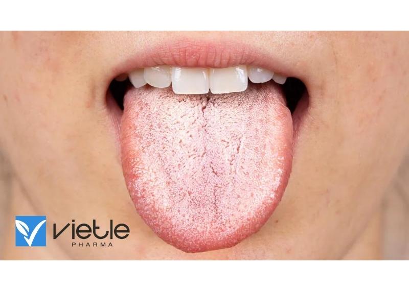 BỆNH TƯA MIỆNG VÀ NHỮNG ĐIỀU CẦN BIẾT