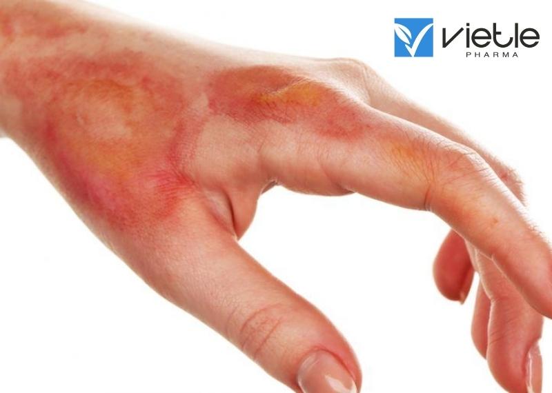 BỎNG DA LÀ GÌ VÀ HƯỚNG DẪN ĐIỀU TRỊ