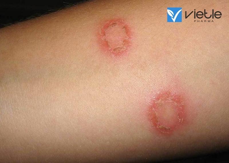 CHÀM: NGUYÊN NHÂN, TRIỆU CHỨNG VÀ CÁCH ĐIỀU TRỊ