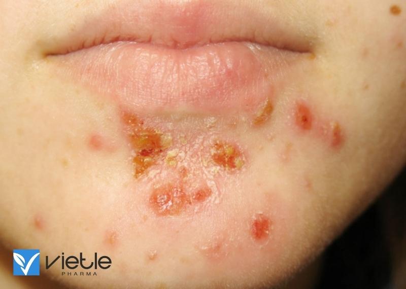 CHỐC LỞ LÀ GÌ, TRIỆU CHỨNG VÀ CÁCH ĐIỀU TRỊ